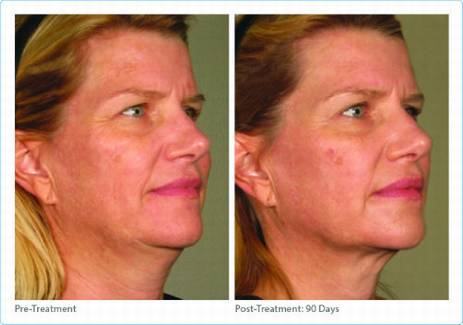 Ultherapy skin tightening Dr Varano Washington DC & Virginia Ultherapy skin tightening Dr Varano Washington DC & Virginia